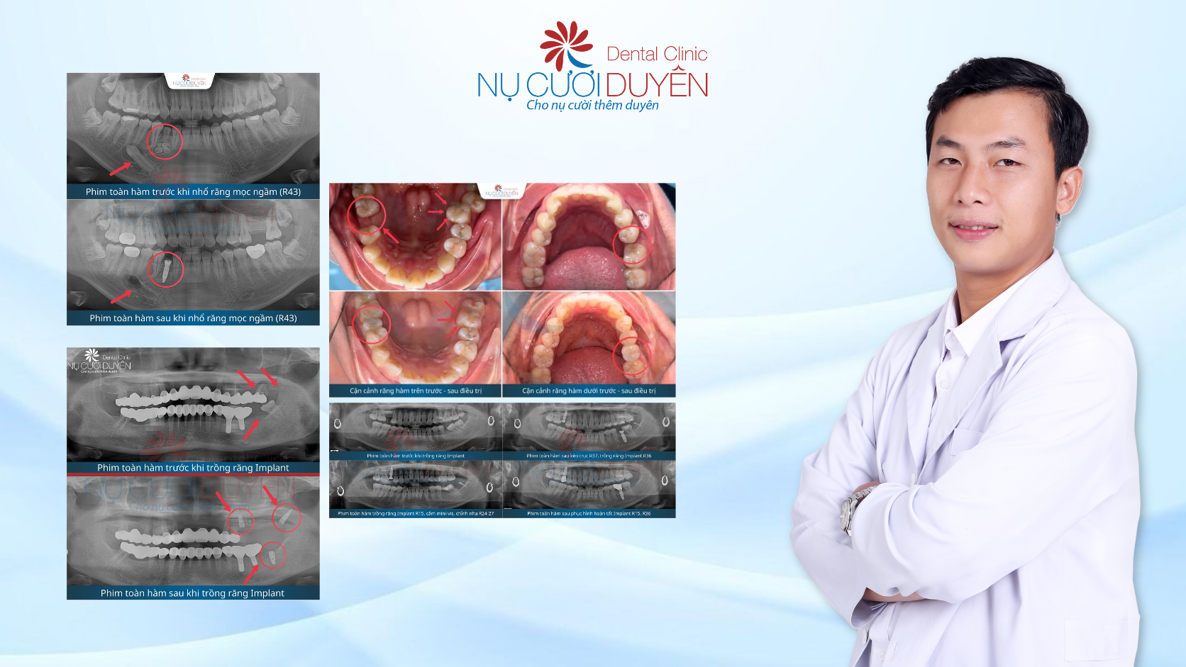 B&aacute;c Sĩ đ&atilde; c&oacute; kinh nghiệm qua h&agrave;ng ng&agrave;n trường hợp cấy gh&eacute;p
